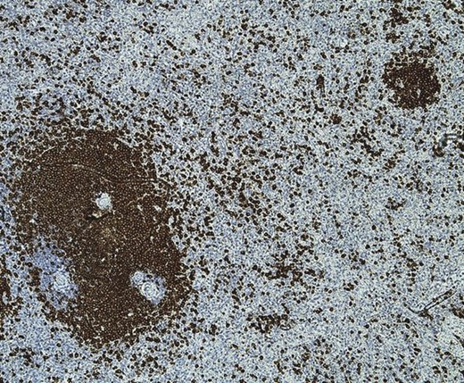 CD79a immunohistochemistry ×20. CD79a highlights the presence of marginal expansion of the white pulp lymphoid mantle with satellitosis (nodular infiltrates) in the red pulp. The monomorphic population of medium-sized lymphoid cells also stained positive for CD20, Bcl2, IgM and IgG consistent with SMZL.