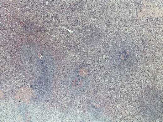 Marginal expansion of the white pulp lymphoid mantle with satellitosis in the red pulp.