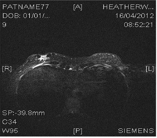 MRI image demonstrating right inframammary breast mass within an accessory breast.