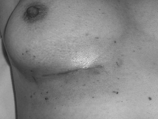 Clinical photograph illustrating the acute radiation reaction on patient's skin at completion of her electron beam therapy.