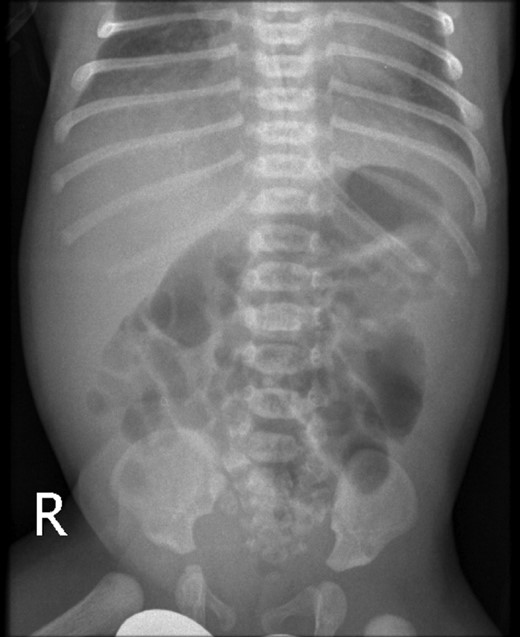 Plain X-ray abdomen on Day 3 of life showing a dilated stomach and duodenum with gas in the distal small bowel.