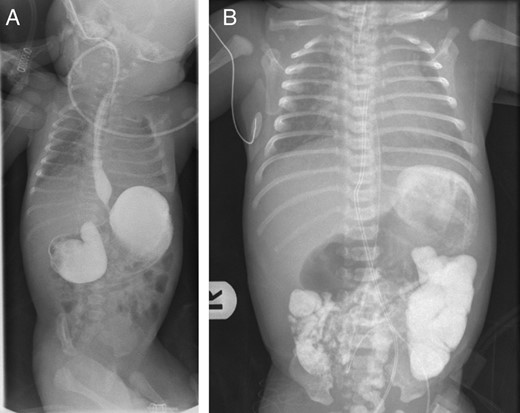 (A) Upper gastrointestinal contrast study showing a markedly distended stomach and duodenal bulb, with narrowed second part of duodenum suggesting congenital duodenal obstruction. (B) Delayed film of upper gastrointestinal contrast study showing dye passing distally suggestive of incomplete obstruction