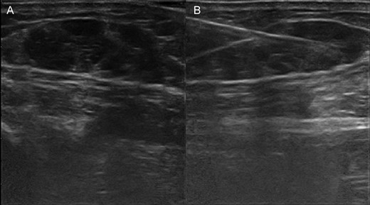 (A) Ultrasonography shows in-transit metastases by malignant myoepithelioma in the soft tissue of the leg. (B) Performing fine-needle aspiration under ultrasonography guide of the in-transit metastases of the leg.