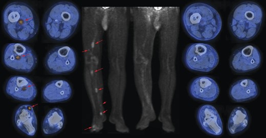 On the left side: images (transaxials fused and maximum intensity projection) of pre-HILP 18F-fluorodeoxyglucose (18F-FDG) PET/CT showing areas (red arrows) of increased uptake representing in-transit metastases in the right lower limb, extending to the thigh; on the right side: images (transaxials fused images and maximum intensity projection) of post-HILP showing clear reduction of pathological uptake of 18F-FDG.