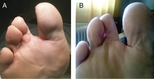 (A) Local recurrence of STMM on the third toe. (B) Disappearance of local recurrence of STMM on the third toe (post-HILP).