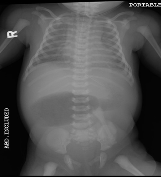 Pre-operative abdominal x-ray showing a gastric and duodenum distention with paucity of small bowel gas distally, suggesting duodenal atresia and malrotation.