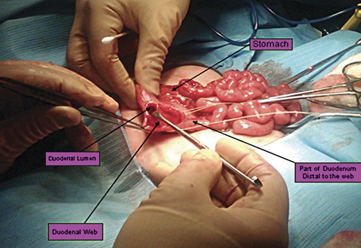 Intra-operative picture showing a duodenotomy incision that reveals a duodoneal web (marked by arrow).