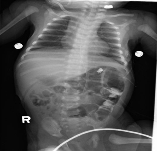 Post-operative abdominal x-ray showing gas throughout the bowel and residual contrast in the descending colon.