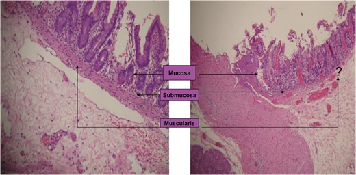 Microscopic examination showing a normal portion of duodenum with a full thickness of the wall and duodenal web lacking the muscularis propria layer.