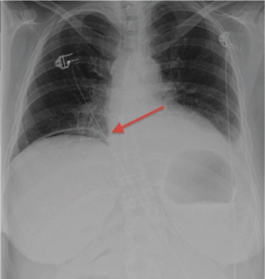 Acute abdominal series demonstrating free air under the right hemidiaphragm.