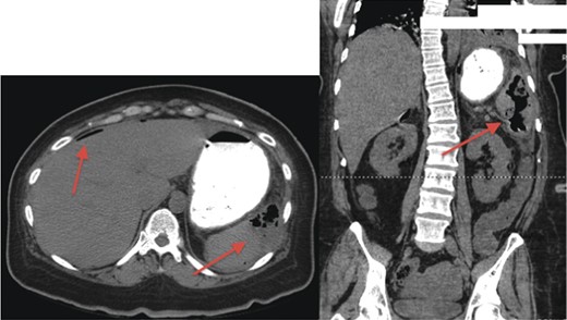 CT scan demonstrating gas-forming splenic abscess and free air in the peritoneal cavity.