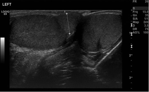 Transverse ultrasonography of the scrotum. A mass is seen attached to the left testicle with the same echo pattern as the normal testicular tissue.
