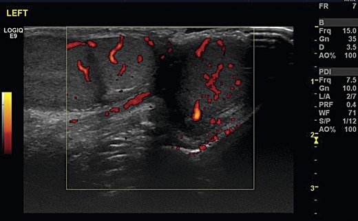 Transverse ultrasonography of the scrotum. A mass is seen attached to the left testicle with the same vascularity as surrounding testicular tissue.