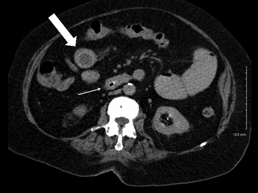 Axial CT image demonstrating gallstone in proximal ileum (block arrow) and distal ileal luminal narrowing (thin arrow).