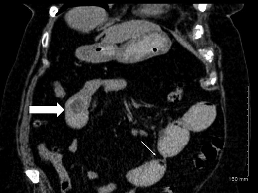 Coronal CT image demonstrating gallstone ileus (block arrow) and stricture in distal ileum (thin arrow).