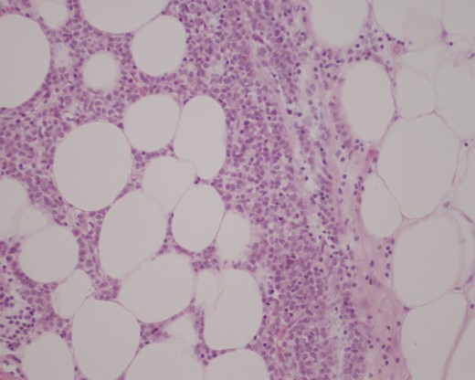 Haematoxylin and eosin (H&E) stain of proximal ileum showing focal metastatic breast carcinoma in mesenteric tissue (medium power field).