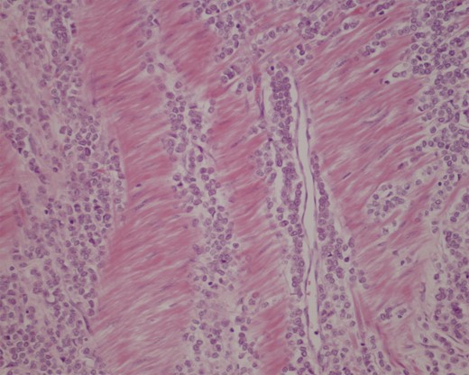 Immunohistochemical stain of distal ileal resection showing an extensive transmural involvement by metastatic carcinoma (×200).