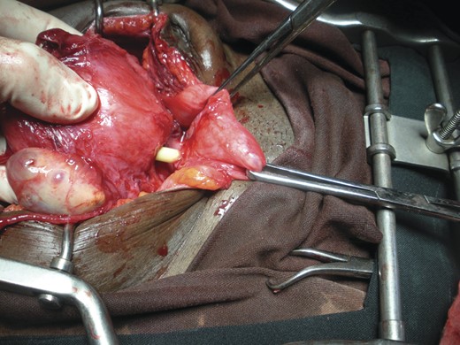 Vesicouterine catheter. Vesicouterine fistula clearly demonstrated the catheter found passing through the bladder (reflected to the right by Babcock clamps) to the uterus. Primary author's personal photograph.