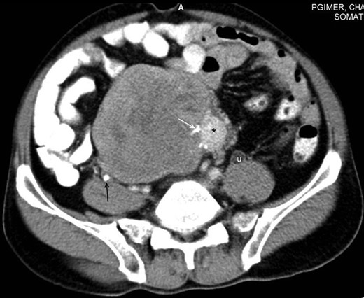 Axial section of contrast-enhanced CT of the abdomen reveals a large heterogeneously enhancing mass with a small hyperenhancing component (asterisk). Foci of calcification are noted within the lesion (white arrow). A few hypoenhancing areas are also seen within the lesion, which might represent necrosis or scar formation. Incidentally, a ureteric calculus is seen on the right side (black arrow). Dilated ureter (u) is noted on the left side due to compression by the mass lower down. Note that the fat planes with the bowel and the retroperitoneal vessels are maintained.