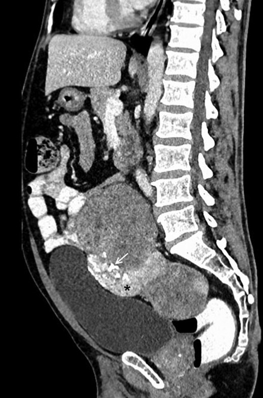 Contrast-enhanced sagittal reformatted CT section of the abdomen depicts a large enhancing mass posterior to the urinary bladder and anterior to the lower lumbar vertebrae and sacrum. The lesion is heterogeneously enhancing with a small hyperenhancing component (asterisk). Foci of calcification are noted within the lesion (white arrow). Note that the fat planes with the bowel and the urinary bladder are maintained.