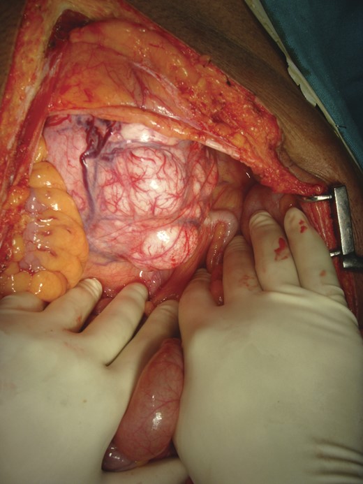 Intra-operative picture: a 20 × 13 cm solid well-encapsulated tumor was present in the pelvic cavity posterior to urinary bladder.