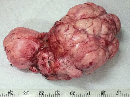 Tumor after en bloc excision.