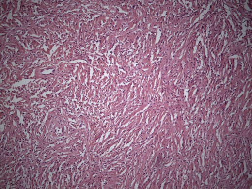 Microphotograph showing short interlacing spindle cells in short fascicles with intervening thick collagen (H&E Ă— 200).