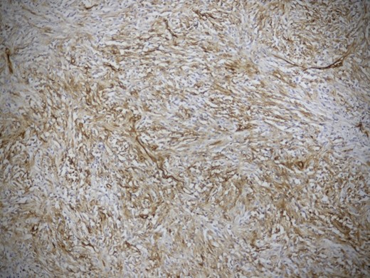 Microphotograph showing a strong CD 34 positivity in the tumor cells (IHC Ă— 200).