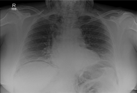 Chest X-ray illustrating pneumoperitonuem, pneumomediastinum and cervical emphysema.