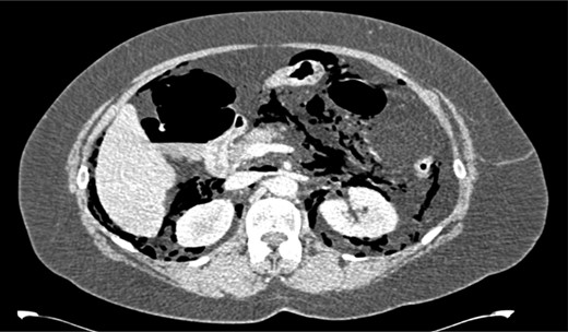 CT scan showing an extensive pneumoretroperitoneum.