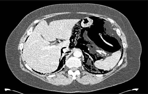 CT scan of abdomen showing free intraperitoneal gas compressing the splenic flexure.