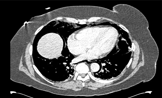 CT scan of chest showing an extensive pneumomediastinum.