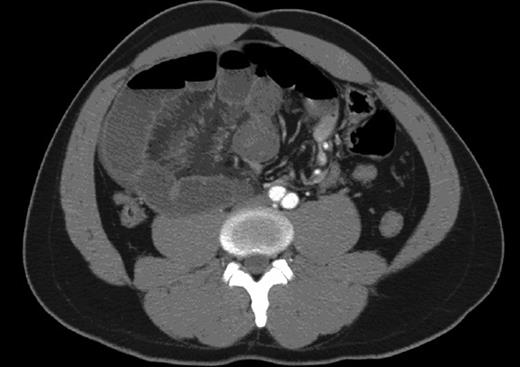 This CT demonstrates dilated small-bowel loops and a whirling sign suggestive of mesenteric and bowel congestion with bowel thickening consistent with ischemia.