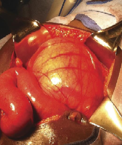 Intra-operative findings demonstrating a distended small bowel mass, enclosed in a membrane, which was encountered on entering the peritoneum.