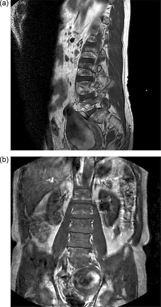 (a) T1-weighted sagittal MRI showing internal iliac aneurysm. (b) T1-weighted coronal MRI showing internal iliac aneurysm.