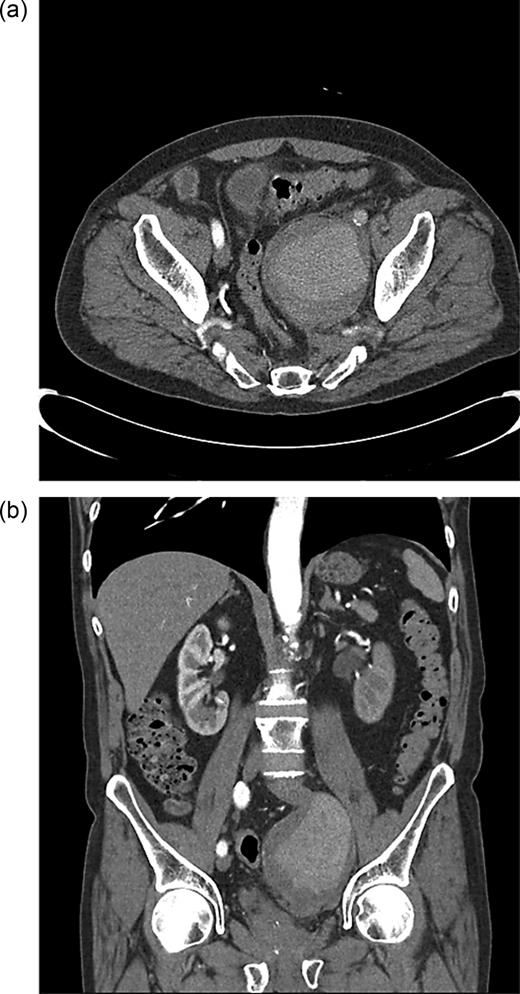 (a) Axial CT of the pelvis. (b) Coronal CT of the pelvis.