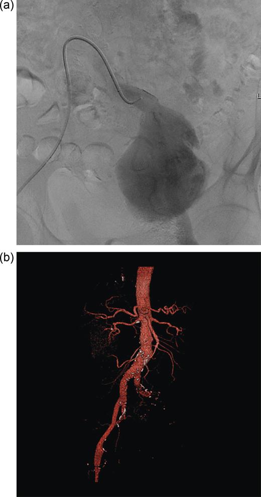(a) Endovascular catheterization showing aneurysm to be blind ending. (b) 3D CT reconstruction showing blind ending aneurysm.