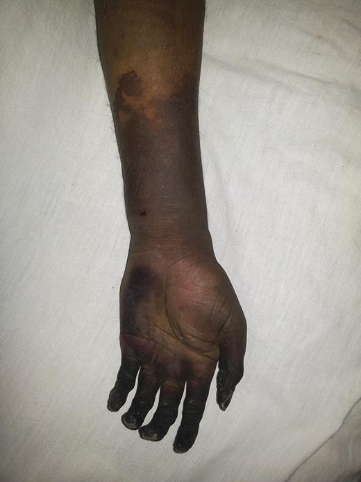 The gangrenous left hand and forearm.