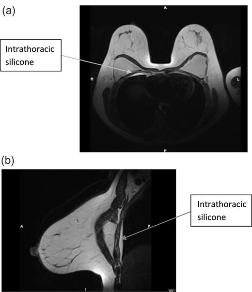 (a) MRI breast cranio-caudal view and (b) MRI breast medio-lateral view.