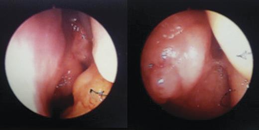 Images from left-sided rigid endoscopy demonstrating an abnormal cystic mass.