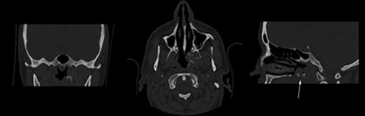 Initial CT images of sinonasal lesion.