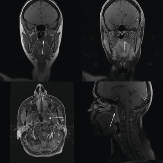 MRI images of sinonasal lesion.
