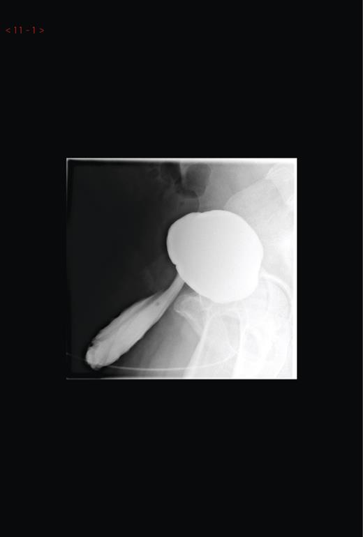 Micturating cystourethrogram showing contrast in the left hemiscrotum.