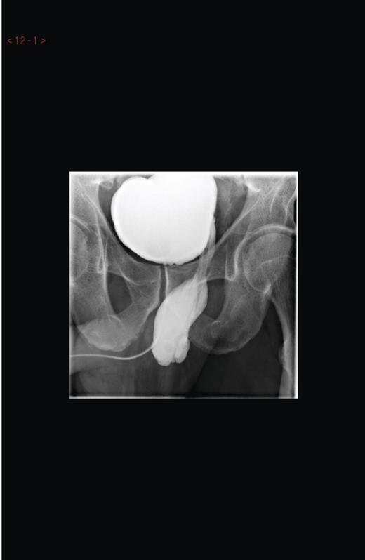 Micturating cystourethrogram showing contrast in the left hemiscrotum.