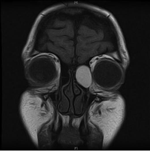 MRI orbits—coronal view.
