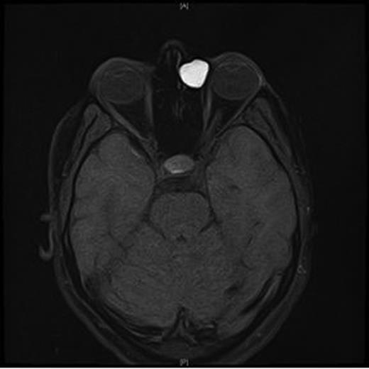 MRI orbits—axial view.