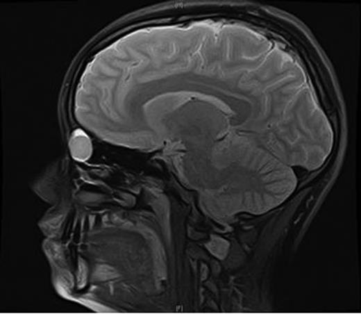 MRI orbits—sagittal view.