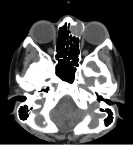 CT orbits—axial view.