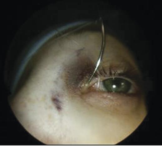 Probing of the left superior puncta.