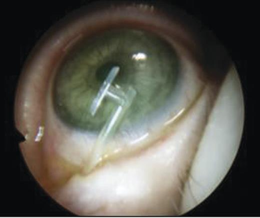 Insertion of DCR stent.